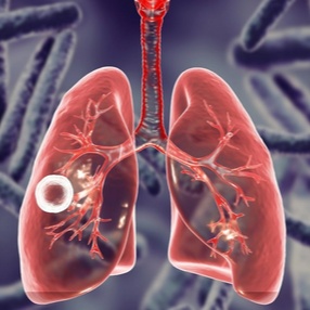 Профилактика туберкулеза: важные меры для защиты здоровья